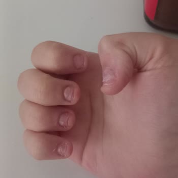 Protez Tırnaklar 4 Günde Çıktı, İlgisiz Ve Memnuniyetsiz Hizmet
