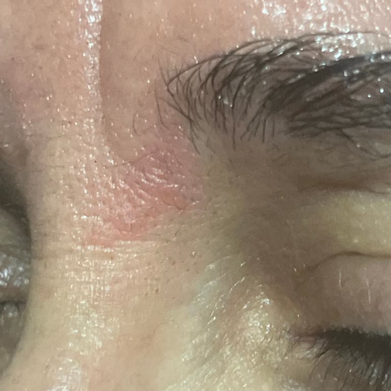 Krem Yüzde Yanma Ve Kaşıntı Yaptı, SKT Bilgisi Yok