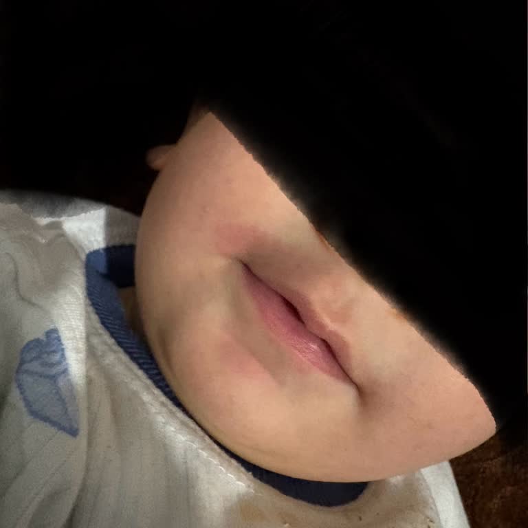 Bebeklerde Alerjik Reaksiyon Ve Egzama Endişesi