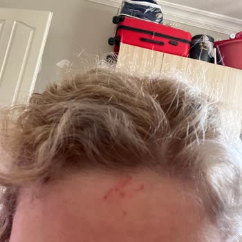 Palette Saç Boyası Alnımda Yaraya Sebep Oldu