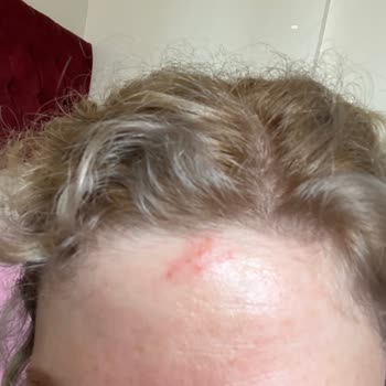 Palette Saç Boyası Alnımda Yaraya Sebep Oldu