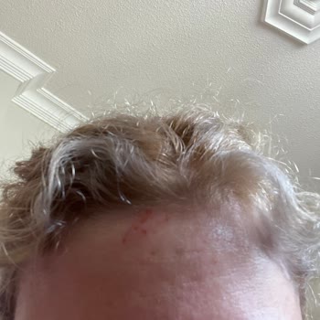 Palette Saç Boyası Alnımda Yaraya Sebep Oldu