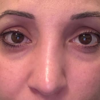 Vanity Estetik Burun Ameliyatında Beklentilerimin Karşılanmaması Ve İlgisizlik