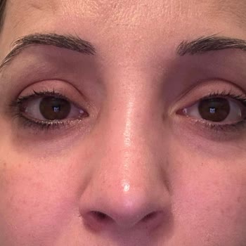 Vanity Estetik Burun Ameliyatında Beklentilerimin Karşılanmaması Ve İlgisizlik