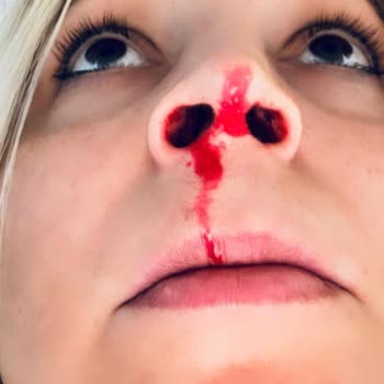 Vanity Estetik Burun Ameliyatında Beklentilerimin Karşılanmaması Ve İlgisizlik