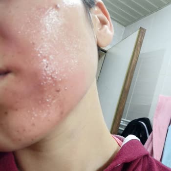 Cilt Serumu Kullanımı Sonrası Yaşanan Cilt Yanığı Ve Yetersiz Müşteri Hizmeti