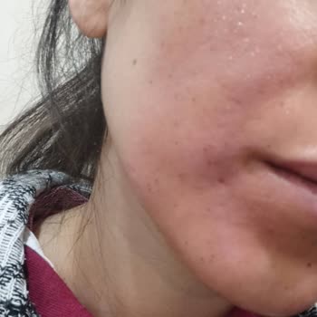 Cilt Serumu Kullanımı Sonrası Yaşanan Cilt Yanığı Ve Yetersiz Müşteri Hizmeti