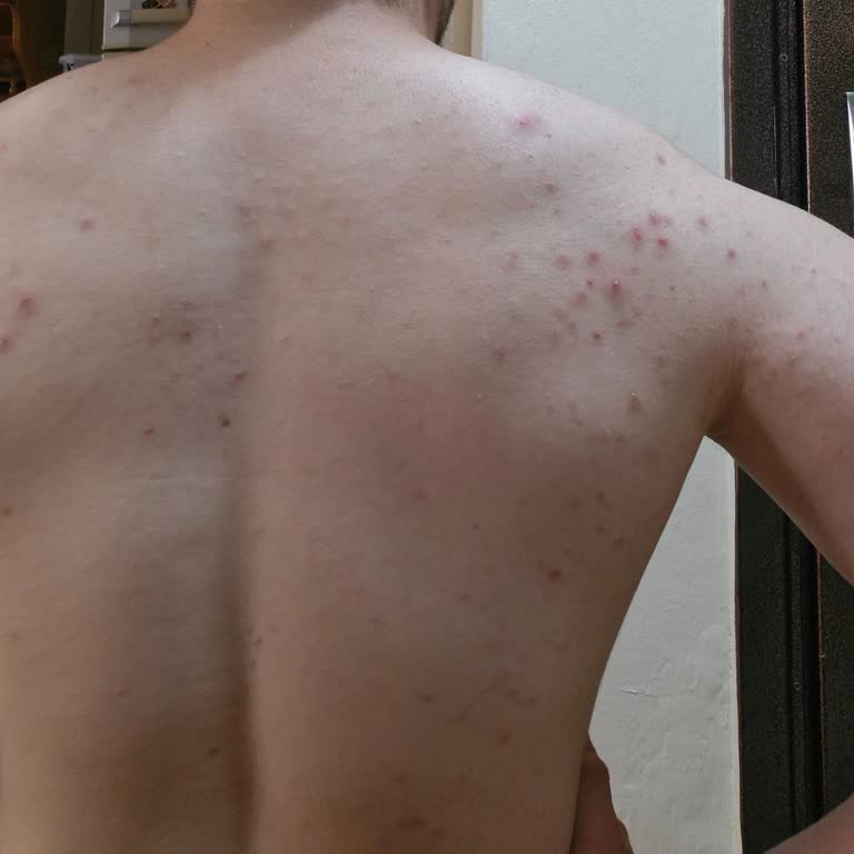 Veet Tüy Dökücü Krem Sonrası Sırtımda Tahriş Ve İltihaplı Sivilceler Oluştu