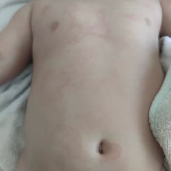 Prima Bebek Bezi Bebeğimde Alerji Ve Mağduriyet Yarattı