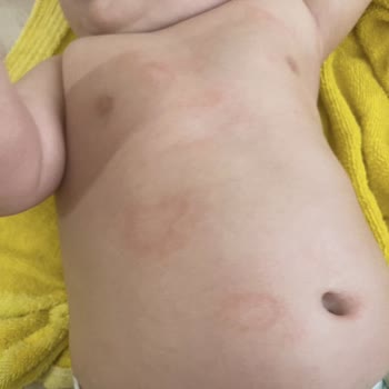 Prima Bebek Bezi Bebeğimde Alerji Ve Mağduriyet Yarattı