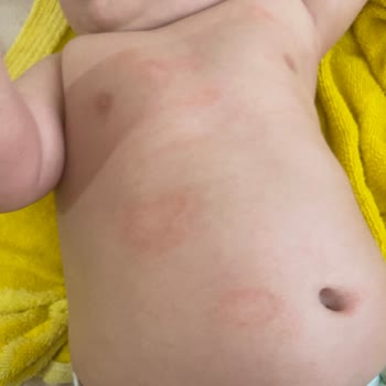 Prima Bebek Bezi Bebeğimde Alerji Ve Mağduriyet Yarattı