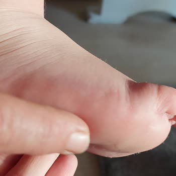 Skechers Ayakkabı Çocuğumun Ayağını Yaraladı