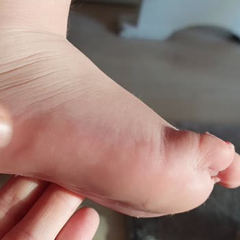 Skechers Ayakkabı Çocuğumun Ayağını Yaraladı