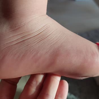 Skechers Ayakkabı Çocuğumun Ayağını Yaraladı