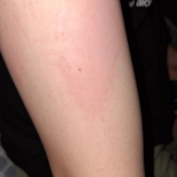 Santa Farma Thermoflex Kızarıklık Yaptı