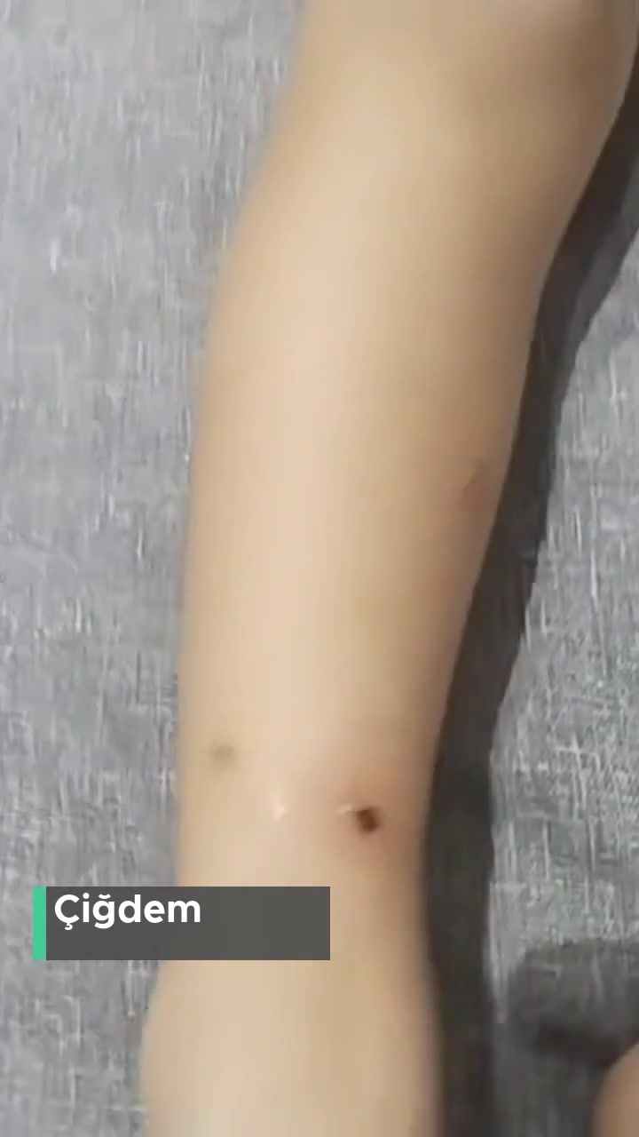 Mersin Büyükşehir Belediyesi Çocuğum Pire Isırığından Acı Çekiyor videonun kapak resmi