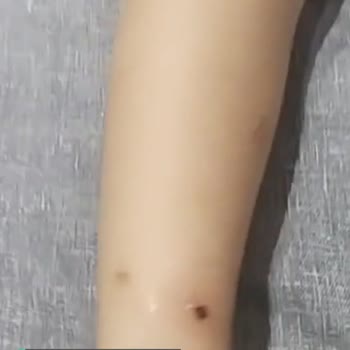 Mersin Büyükşehir Belediyesi Çocuğum Pire Isırığından Acı Çekiyor