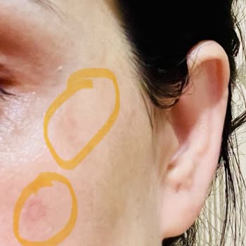 Yanlış Dermapen Uygulaması Sonrası Cilt Lekelerim Arttı Ve Tedavi Sürecim Uzadı