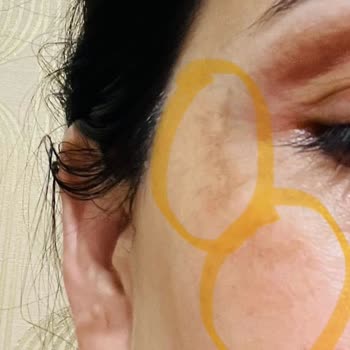 Yanlış Dermapen Uygulaması Sonrası Cilt Lekelerim Arttı Ve Tedavi Sürecim Uzadı