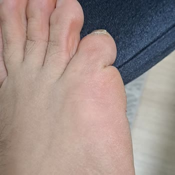 Ayakkabı Ayağımı Mahvetti, İade Talebim Reddedildi!