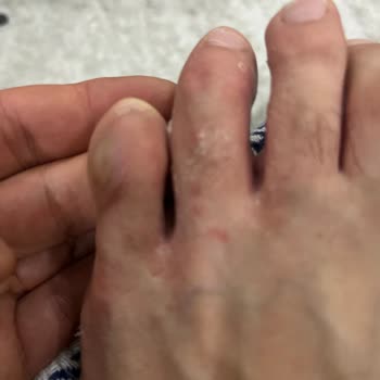 Skechers Ayakkabı Ayağımı Rahatsız Etti, İade Talebim Reddedildi