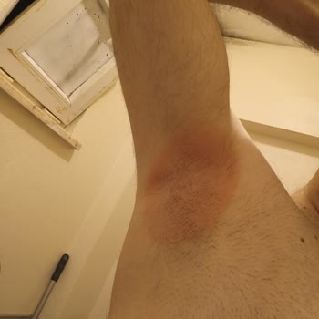 Yves Rocher Roll On Şiddetli Kaşıntı Ve Yanma Yaptı