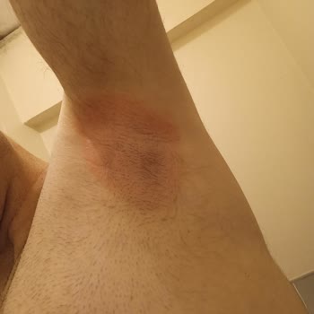 Yves Rocher Roll On Şiddetli Kaşıntı Ve Yanma Yaptı