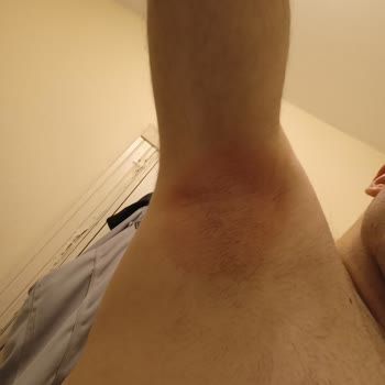 Yves Rocher Roll On Şiddetli Kaşıntı Ve Yanma Yaptı