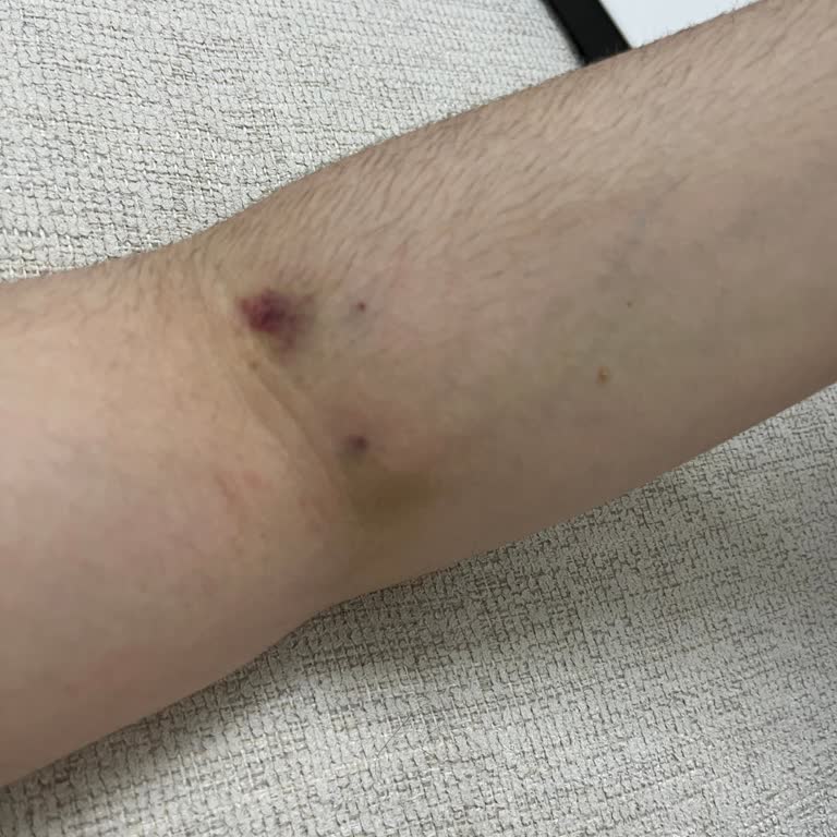 Hatalı Damar Yolu Açılması Ve İlgisiz Hemşire Nedeniyle Güven Kaybı