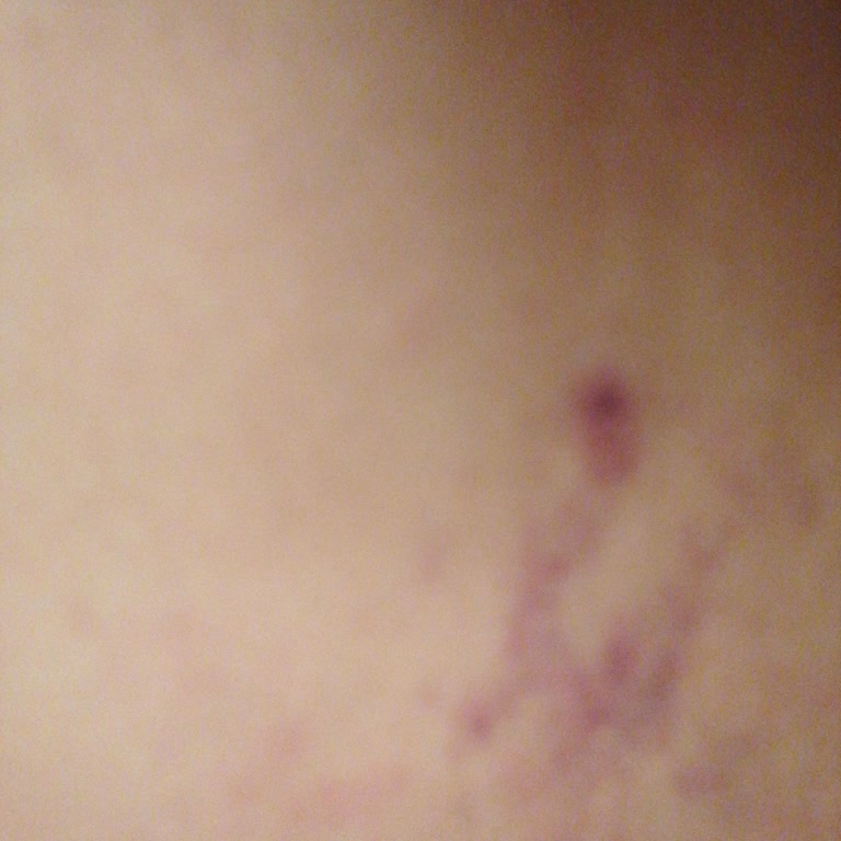 Randevuya Geç Kaldılar, Aceleyle Yapılan İşlem Sonucu Bacaklarım Morardı