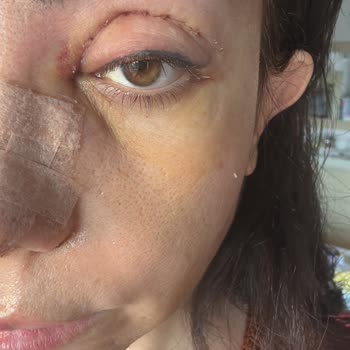 Ameliyat Sonrası Yüzde Meydana Gelen Sorunlar ve Hasta Memnuniyetsizliği