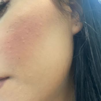 Serum Paketi Sonrası Cildimde Olumsuz Reaksiyonlar Oluştu