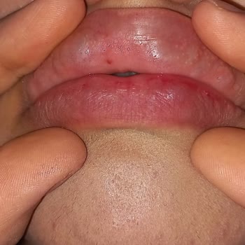 İğneli Dolgu Sonrası Yaşanan Olumsuz Deneyim Ve İletişim Sorunları