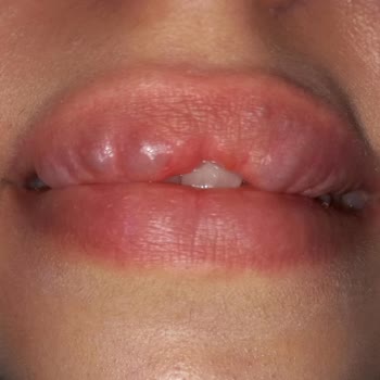 İğneli Dolgu Sonrası Yaşanan Olumsuz Deneyim Ve İletişim Sorunları