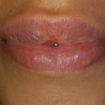 İğneli Dolgu Sonrası Yaşanan Olumsuz Deneyim Ve İletişim Sorunları