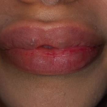 İğneli Dolgu Sonrası Yaşanan Olumsuz Deneyim Ve İletişim Sorunları