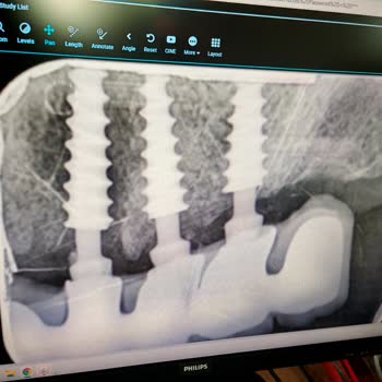 Denge Dent Diş Sağlığı Polikliniği Yanlış Uygulanan İmplant Tedavisi Sonrası Yaşadığım Sorunlar