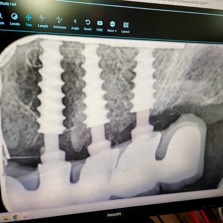 Denge Dent Diş Sağlığı Polikliniği Yanlış Uygulanan İmplant Tedavisi Sonrası Yaşadığım Sorunlar