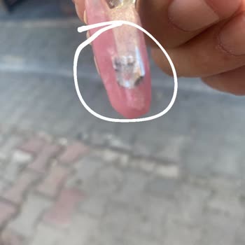 Devlet Hastanesinde Diş Protezinde Hata Ve İlgisizlik