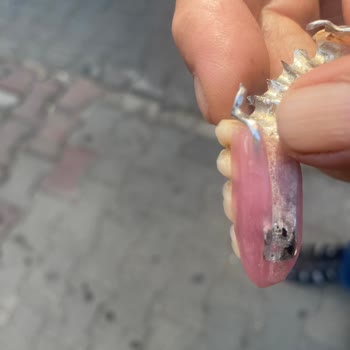 Devlet Hastanesinde Diş Protezinde Hata Ve İlgisizlik