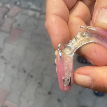 Devlet Hastanesinde Diş Protezinde Hata Ve İlgisizlik