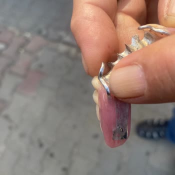 Devlet Hastanesinde Diş Protezinde Hata Ve İlgisizlik