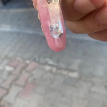 Devlet Hastanesinde Diş Protezinde Hata Ve İlgisizlik