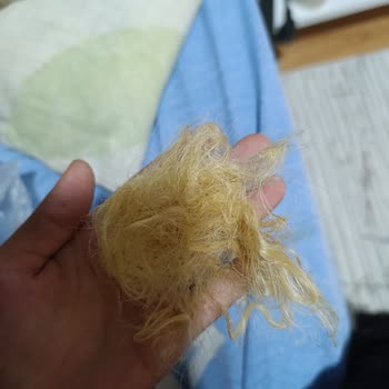 Şampuan Ve Saç Spreyi Kullanımı Sonrası Saç Dökülmesi Ve Psikolojik Etkileri