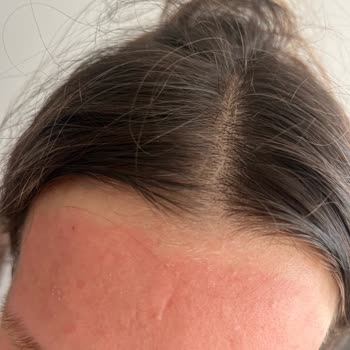 Yüz Bakım Seti Kullanımında Ciltte Yoğun Kızarıklık Ve Yanma