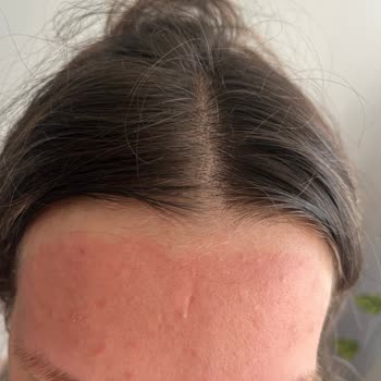 Yüz Bakım Seti Kullanımında Ciltte Yoğun Kızarıklık Ve Yanma