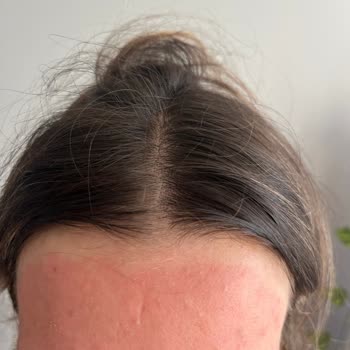 Yüz Bakım Seti Kullanımında Ciltte Yoğun Kızarıklık Ve Yanma