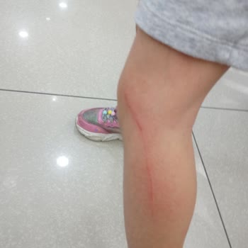 Mağaza Tezgahındaki Plastik Aksam Çocuğumu Yaraladı Yetkili İlgisizdi