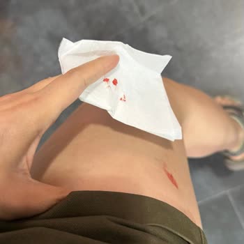 Baydöner Midtown Şubesinde İskender Tabağı Parçası İle Yaralanma Ve İlgisizlik