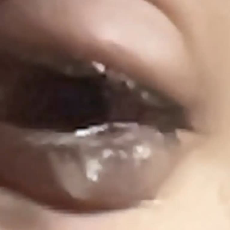 Göz Lazer Ameliyatı Sonrası Ciddi Sağlık Sorunları Ve İlgisizlik